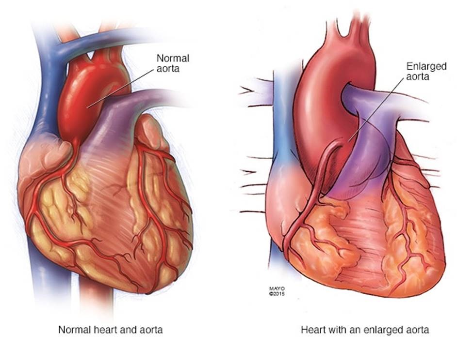 Normal vs Enlarged Aorta