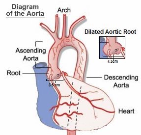 Diagram of the Aorta