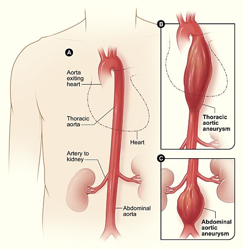 TAneurysm - Thoracic/Abdominal