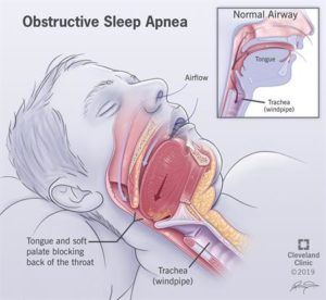 diagram of sleep apnea