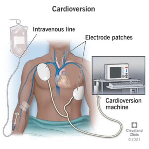 electric cardioversion 