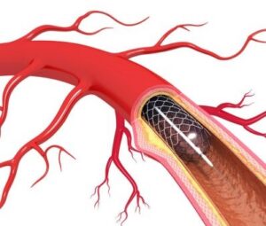 A photo-realistic image of a coronary artery with a stent in it to open up the artery.